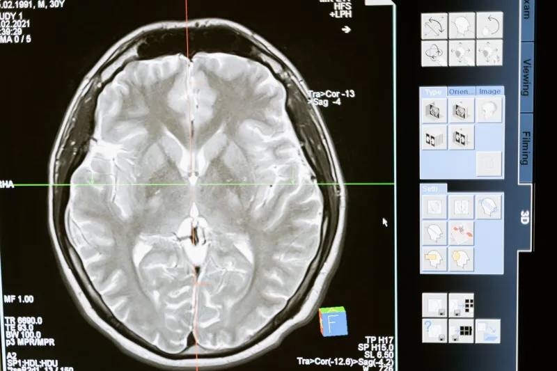 The Auditory System's Failed Cancellation: How Phantom Frequencies Take Hold in the Brain
